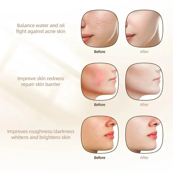 HMiAcne Red Light Therapy For Acne US1